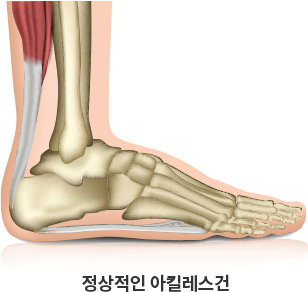 정상적인 아킬레스건