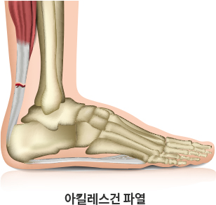 아킬레스건 파열