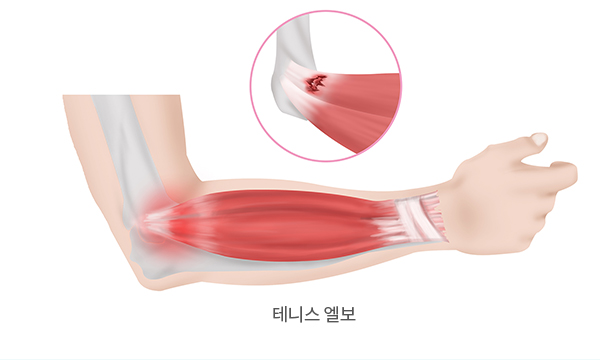 테니스 엘보