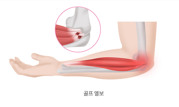 골프 엘보